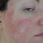 rosacea awareness months - symptoms JulieBC