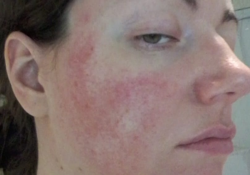 rosacea awareness months - symptoms JulieBC